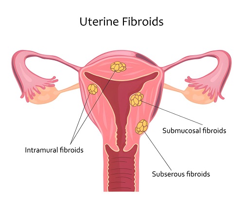 Best Doctor for Nonsurgical Treatment of Uterine Fibroids in Andheri, Mumbai